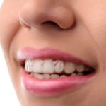 Dentist near Belleville IL Offering Invisalign