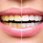 Teeth Whitening O' Fallon, IL